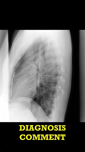 Spine X-ray Spot the Scoliosis! (Rad Short)