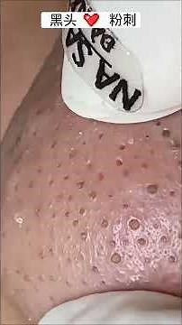 Pincez le point noir sur le nez, la méthode d'élimination des points noirs la plus populaire sur In