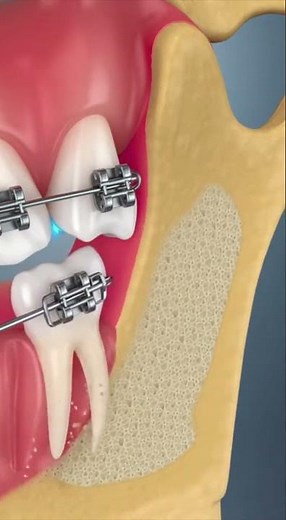 How Braces Actually Move Teeth Time Lapse 🦷