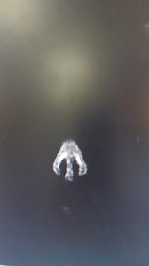 Nasal septum defect due to cocaine abuse