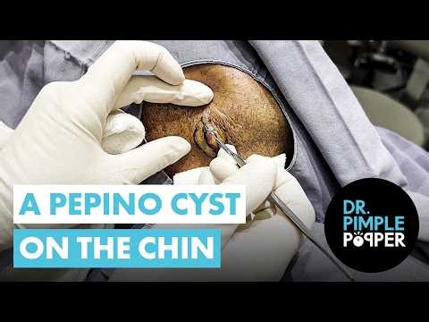 A Pepino Cyst on the Chin - Smooth, Thick, and Fully Satisfying