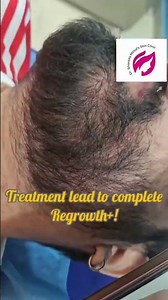 alopecia areata universalis- MBBS MD (MAMC) (SKIN)- HINDI 2025