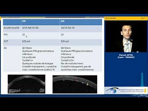 Hypertonie et uvéites : cas clinique (Florent Aptel)