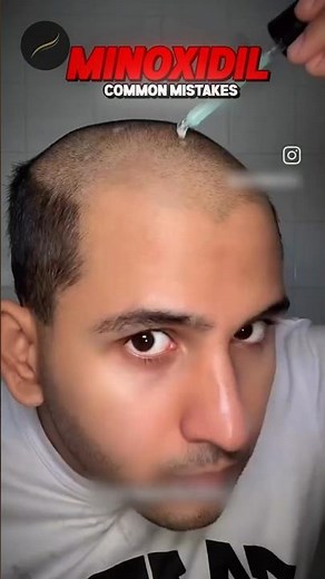 Most People Use Minoxidil Wrong! Here’s How to Apply It Properly #MinoxidilResults