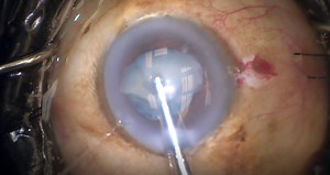 White Cataract and Glaucoma - Eyetube
