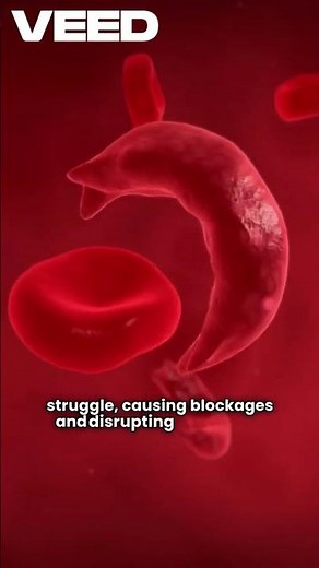 Understanding Sickle Cell Anemia: Causes, Symptoms, and Treatment Options