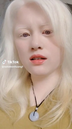 22-year-old Albinism Girl in Zhejiang, China - Unique White Face