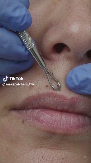 Lip Blackhead Removal: Safe Steps for Clearer Lips