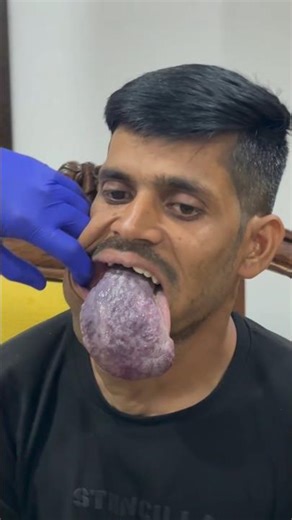 Very Large **Arteriovenous Malformation (AVM) | Rare Vascular Condition Explained