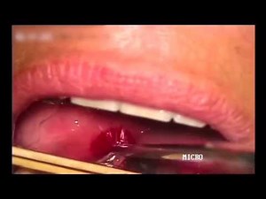 Drenaje de un absceso periamigdalino / Peritonsillar abscess drainage