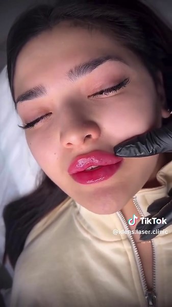 Russian Lips 👄✨ Using just 1ml of filler, we achieved this lifted, heart-shaped pout with the Russian technique — designed to add height, define the Cupid’s bow, and maintain a flat side profile without adding too much volume. Perfect for clients who want a sculpted, lifted look without heaviness. Done at Idens Laser Clinic with expert precision and care. #lip #lipfiller #fyp #goviral #idenslaserclinic