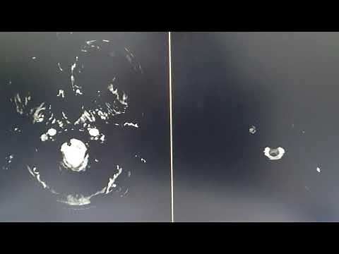 SWI(Susceptibility weighted imaging ) MRI