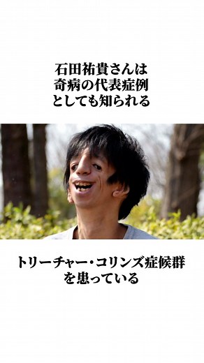 石田祐貴のトリーチャー・コリンズ症候群に関する雑学