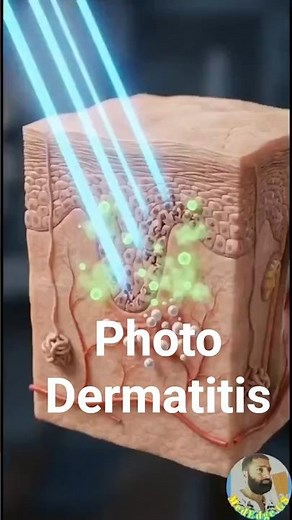 “Sunlight Allergy? The Hidden Skin Reaction Called Photodermatitis”