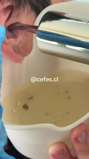 Limpieza de oídos: Solución para el tapón de cera
