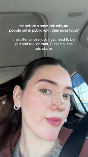 before a nose job I always wondered why people were out with their nose tape like aren’t you hurting? shouldn’t you be at home? Now I understand you’re fine and just need some socialization and exposure to the real world after being stuck at home for what feels like forever. #postop #nosejob #rhino #rhinoplasty