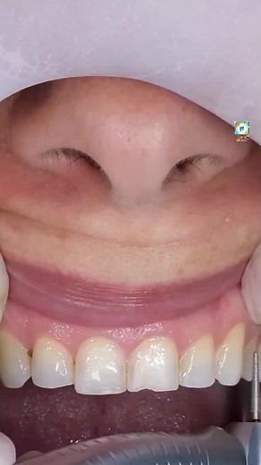 Perfecting Smiles with Endocrown Cementation and Zirconia Crowns
