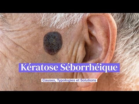 Kératose Séborrhéique : Causes, Typologies et Solutions - Skin Marceau Paris