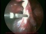 Surgery of Ovarian Cyst - Laparoscopic Method • Video • MEDtube.net