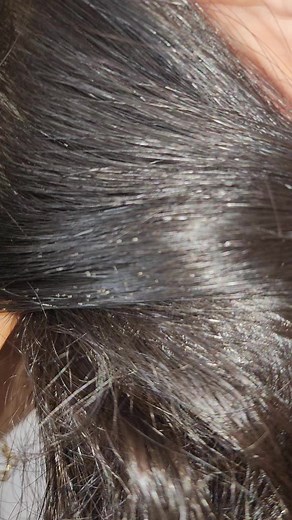 41K views · 105 reactions | Nits are small eggs laid close to the scalp by adult Head Lice. The further away from the scalp, the longer the infestation When they appear white it is because the eggs have hatched and the empty shells remain. My lice comb removes both Lice and Nits! #rgvlicelady #lice #liceremoval #liceprevention #teatreeoil #hairproducts #licecomb #nits #nitcomb #momlife #momstruggles #momsoffacebook #moms #momsofinstagram | LRS - Lice Removal Service | Facebook