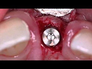 How to extract a tooth with severe resorption