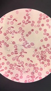 Blood film 😍 #lablife #Hematology #MedicalLabTechnician | Lab life
