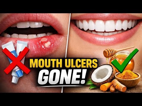 Mouth Ulcer Relief in Minutes! 3 Natural Remedies (No Chemicals) 👄✨