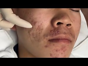 ASMR Acne Treatment | Extreme Blackhead Removal & Skin Cleaning#asmr