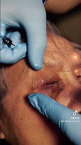 Removing Sutures After Blepharoplasty – Step-by-Step Guide!