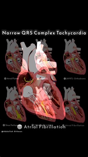 Narrow QRS Tachycardias: A Visual Guide 🫀 A narrow QRS complex tachycardia (