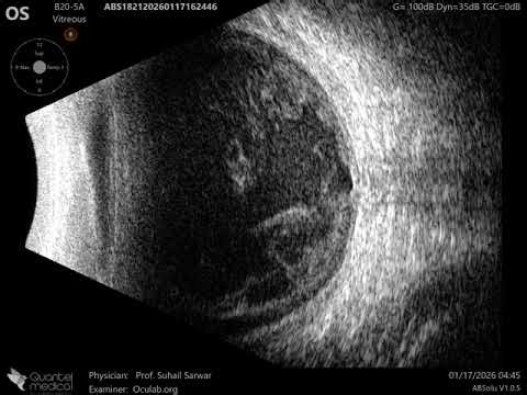 20 MHz Annular Ophthalmic Ultrasound ABSolu, Endophthalmitis , 36927