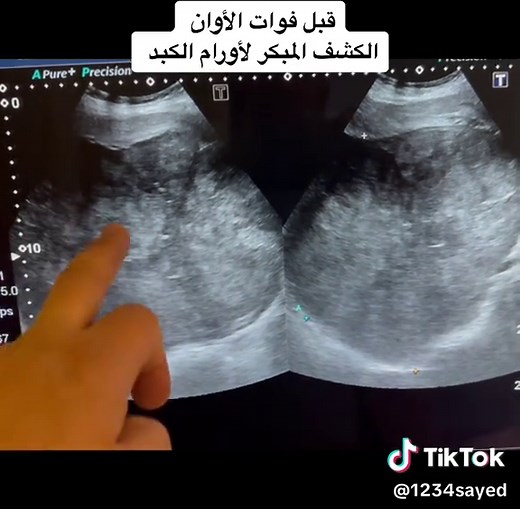 الكشف المبكر عن أورام الكبد وأهميته