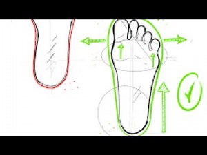 How and why to correct high arches of the foot. (pes cavus)