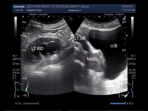 Renal Hydronephrosis with Hydroureter due to the obstruction caused by a pelvic mass.