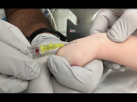 IV Insertion Technique in Infants and Small Children