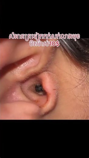 Earwax removal remove insect from ear #8