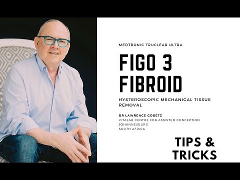 Fibroid hysteroscopic resection tips & tricks with the TruClear™ mechanical tissue removal system