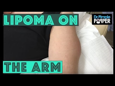 A Lipoma International on the Arm!