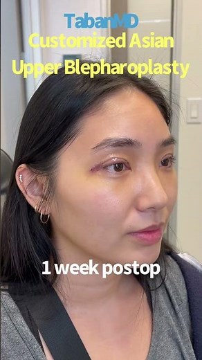 Double Eyelid Surgery - Asian Blepharoplasty by Ray Taban M.D.