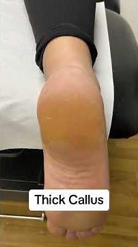 Ultimate Heel Transformation: Watch Podiatrist Remove Thick Callus with Scalpel