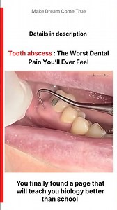 🦷 Tooth abscess : The Worst Dental Pain 😬 You’ll Ever Feel 🩺 | MDCT