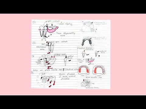 Indirect Retainer in Removable Partial Denture