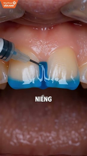 Thưa Răng Cửa Không Phải Cứ Bọc Răng Sứ Là Xong! Xem Ngay 3 Cách Cải Thiện Tình Trạng Thưa Răng Cửa