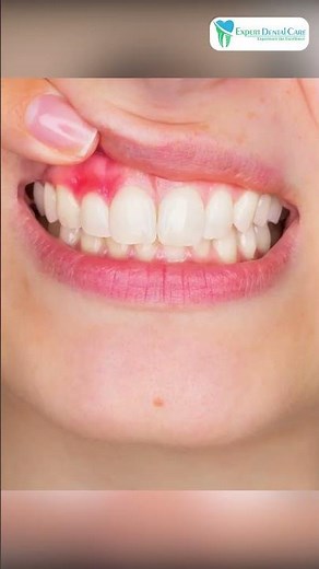 చిగుళ్ళపై చీము, వాపు లాంటి లక్షణాలు ఉన్నాయా || Dental Abscess in Telugu || Expert Dental Care