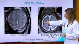 Veja a comparação entre um cérebro normal e um cérebro com microcefalia