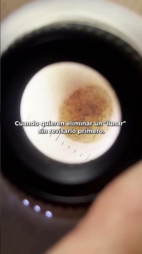 Así vemos un lunar - Dr. Angélica Domínguez Dermatóloga en Bogotá
