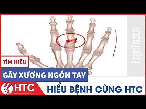 GÃY XƯƠNG NGÓN TAY - Nguyên nhân, triệu chứng, yếu tố nguy cơ