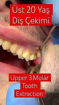 Upper 3.Molar Extraction #dentist #sidedentist #öneçıkar #zahnarzt #tannlege