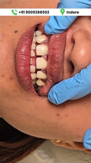 Veneer Placement Live 😍 20 Min Me Perfect Smile! | Indore #shorts
