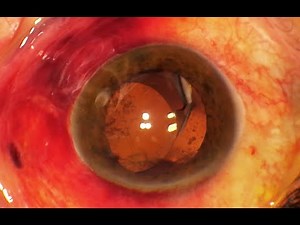 Dislocated IOL in fibrosed capsular bag: release & recenter 2 years after phaco surgery